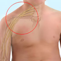 Centre for Brachial Plexus Surgery